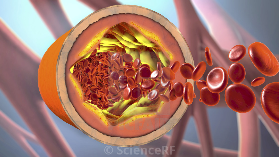 Dr. Hoffer: Mjekimi që përmbys sëmundjet koronare dhe ul kolesterolin e keq